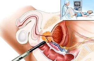 Possibilità per la diagnosi di prostatite