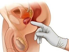 Massaggio prostatico per il trattamento della prostatite negli uomini