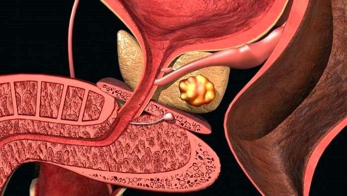 Depositi di calcoli nella prostata nella prostatite calcifica