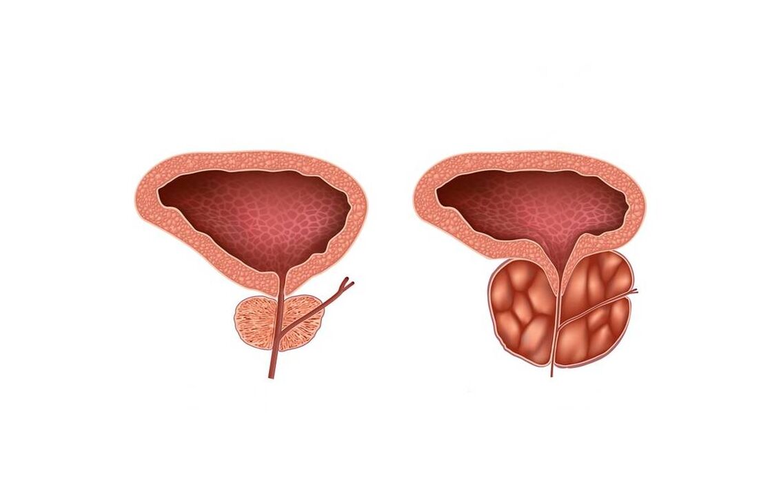 Sintomi della prostatite negli uomini
