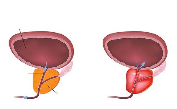 prostata normale e infiammata