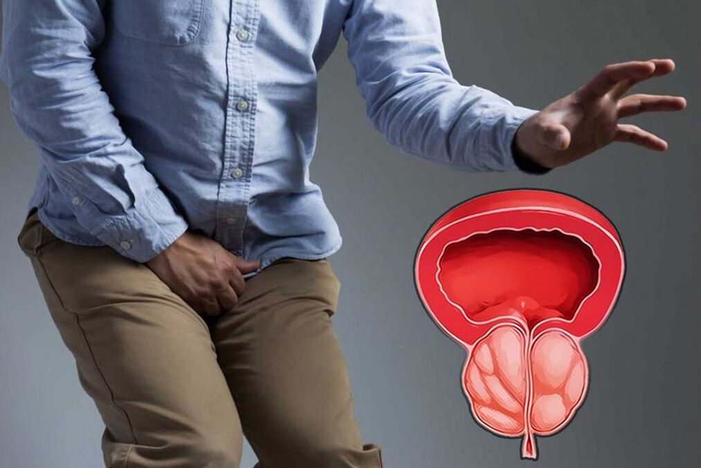 Prostata acuta negli uomini