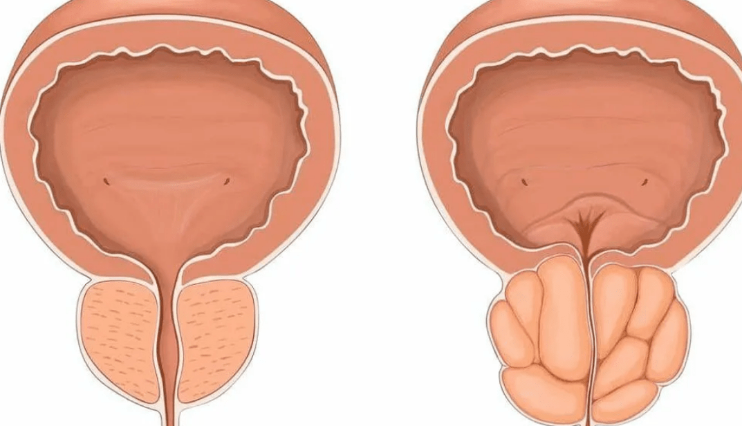 prostata sana e malata